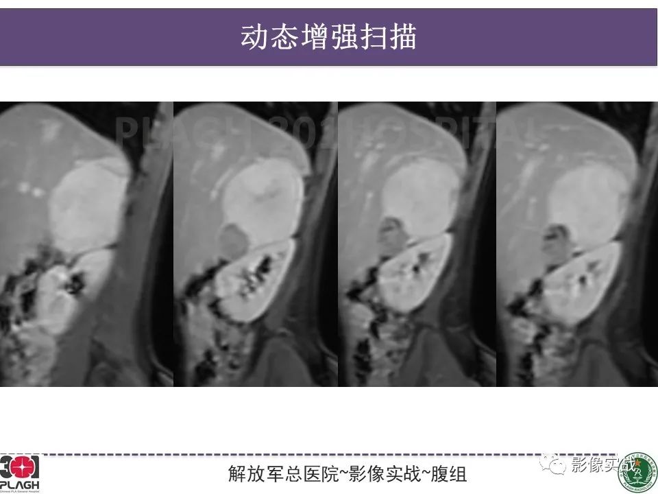 【病例】节细胞神经母细胞瘤1例CT解析思路-15