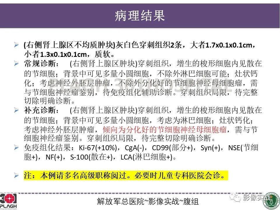 【病例】节细胞神经母细胞瘤1例CT解析思路-29
