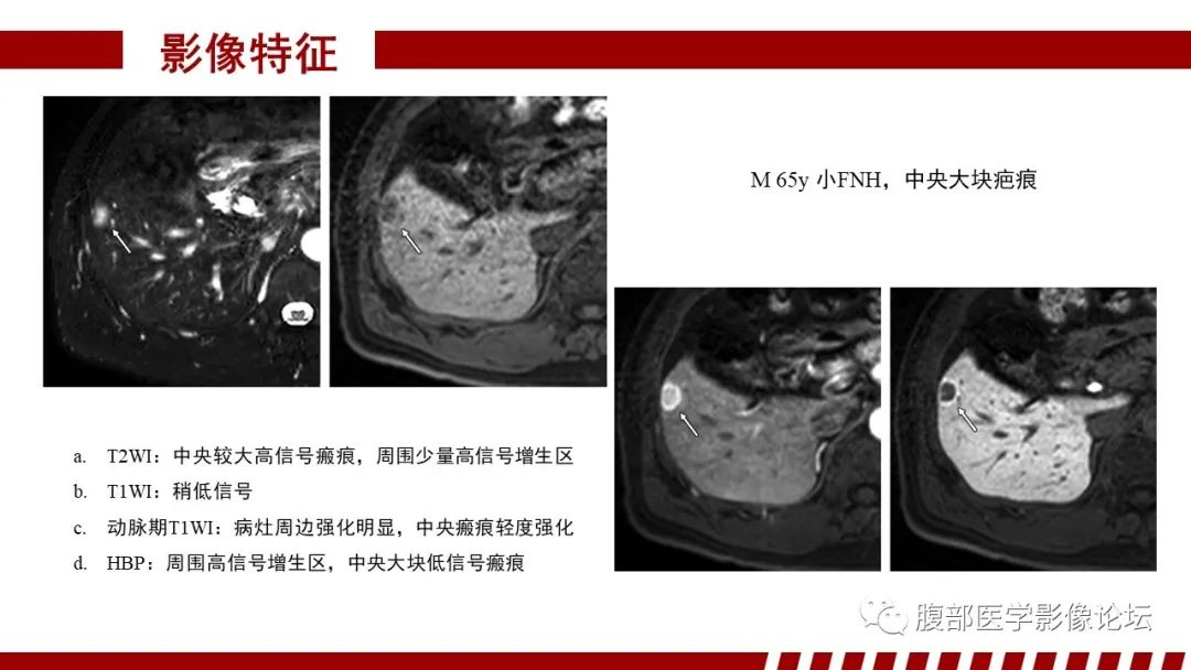 【PPT】肝胆期高信号的病变影像表现及临床意义-21