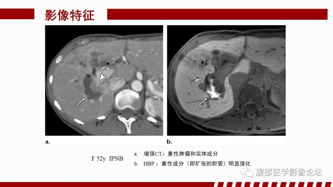 【PPT】肝胆期高信号的病变影像表现及临床意义-66