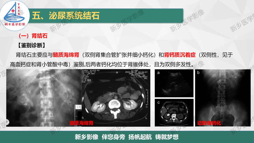 【PPT】泌尿系结石的影像表现及诊断注意事项-8