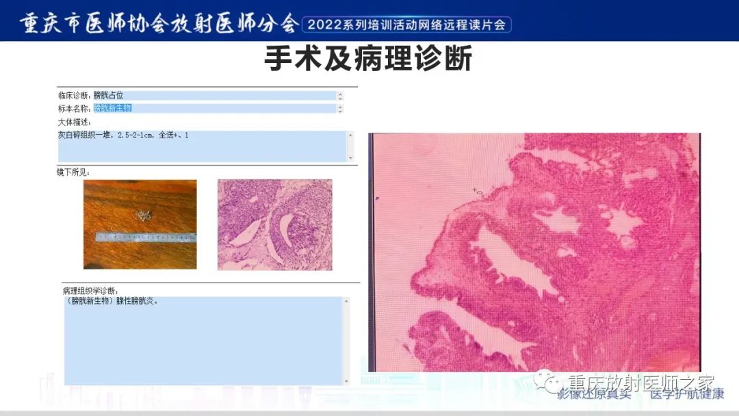 【病例】腺性膀胱炎1例CT影像-9