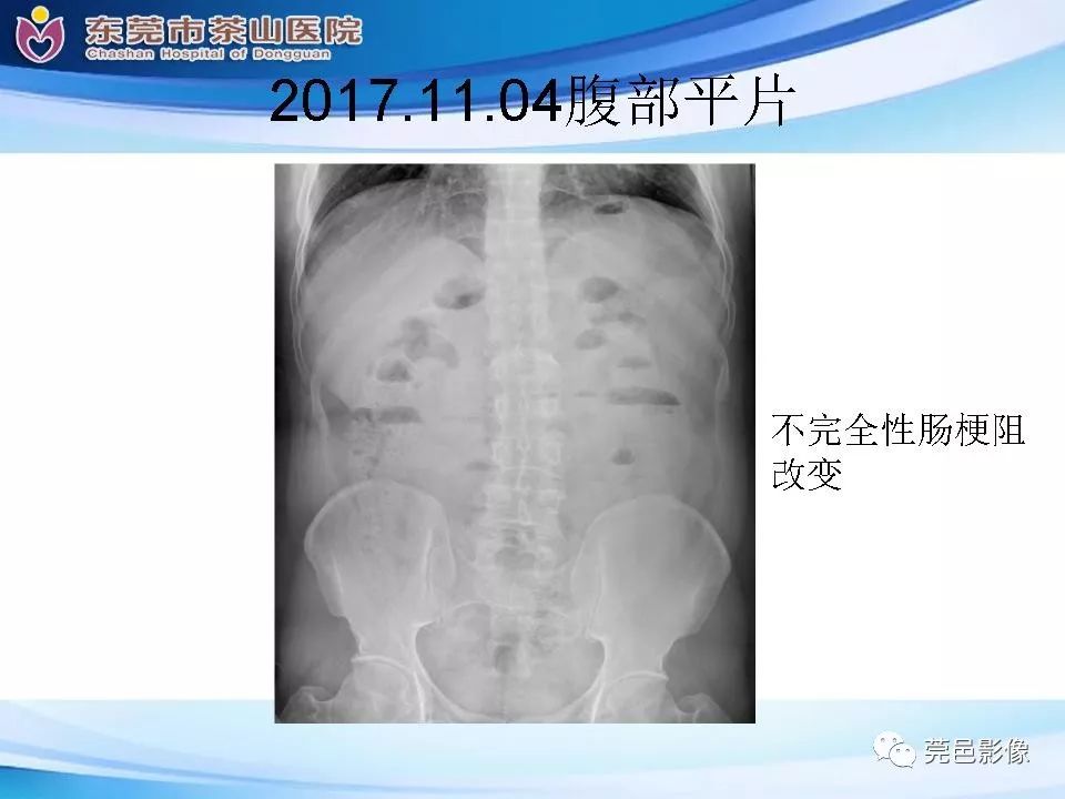 【PPT】腹茧症的影像诊断-6