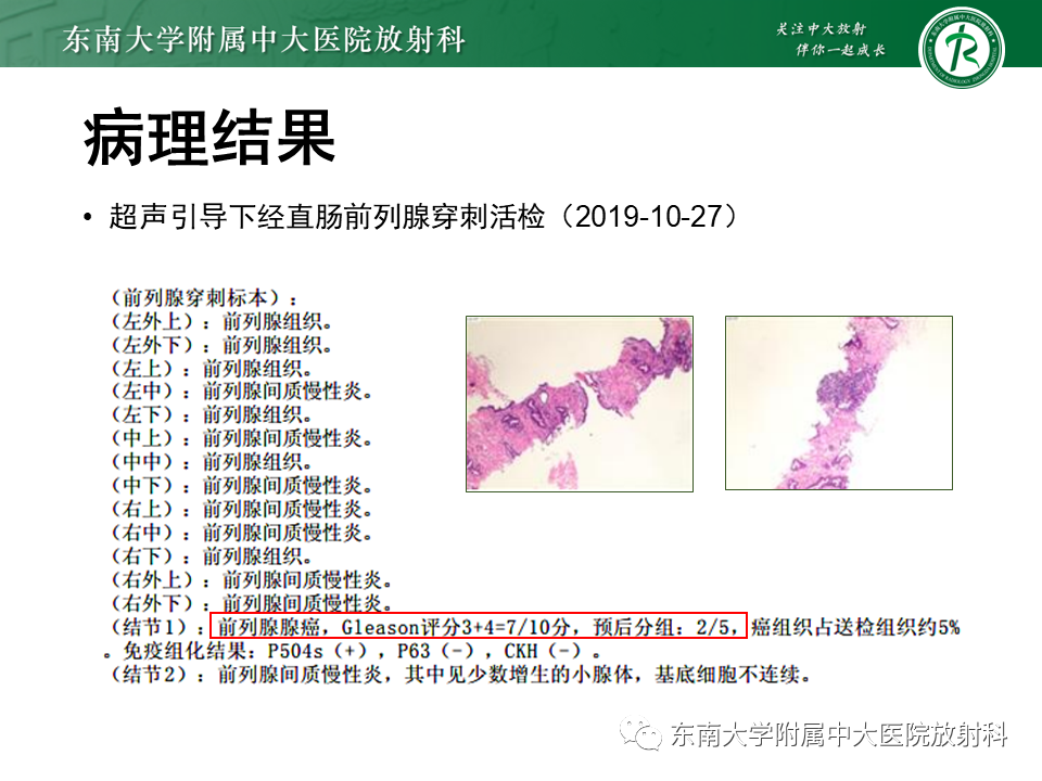 【PPT】前列腺癌-5