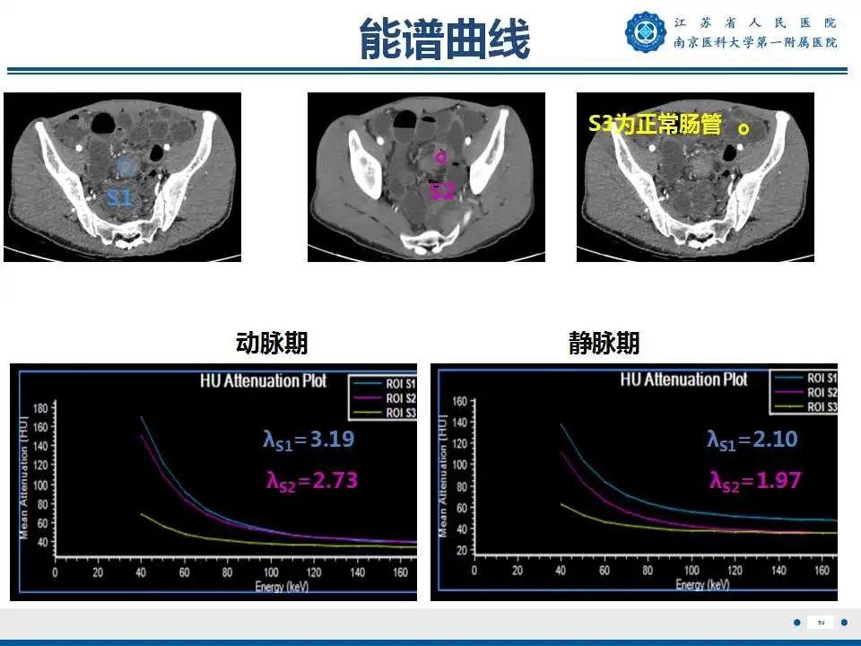 【PPT】克罗恩病-51