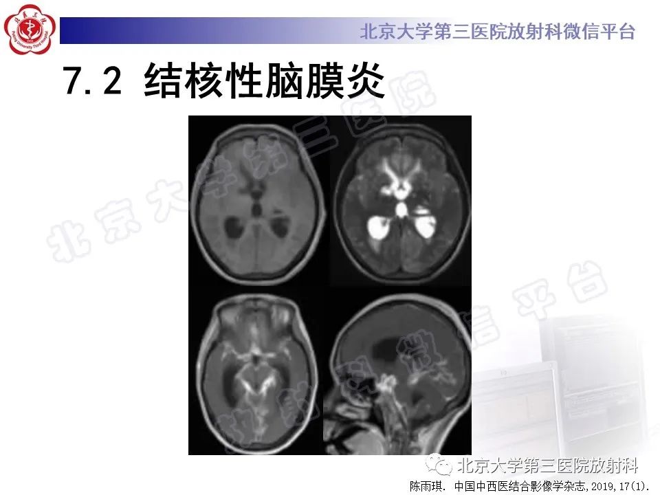 【PPT】脑膜转移瘤-25