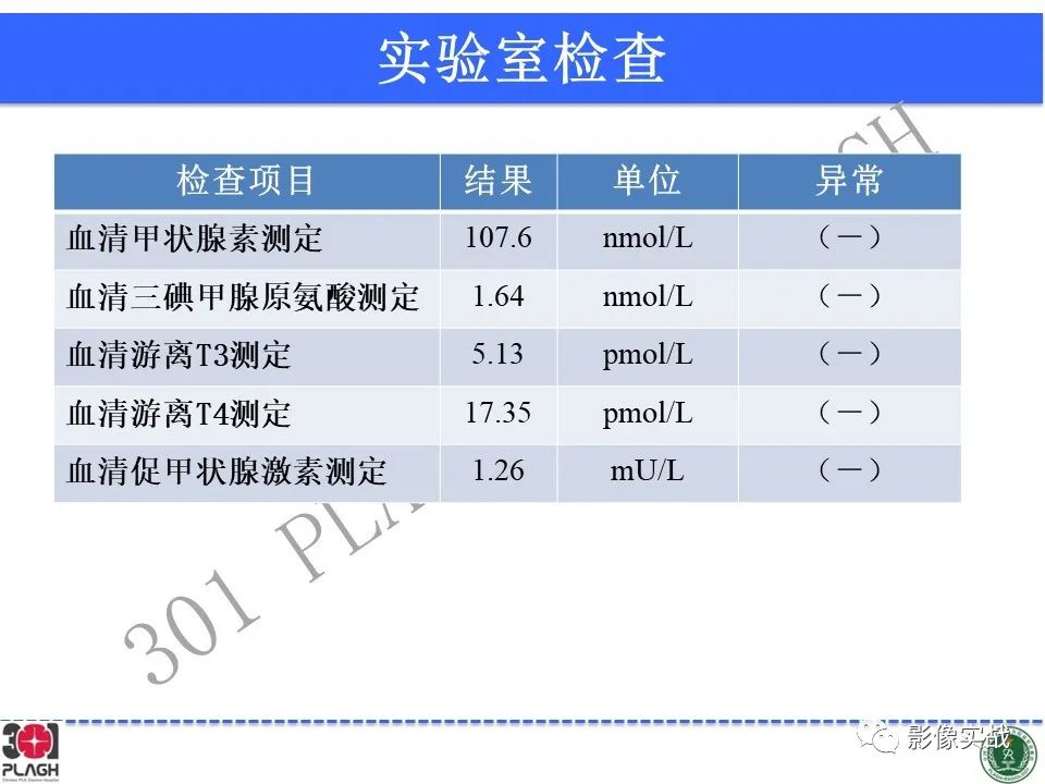 【病例】鞍区孤立性纤维瘤1例CT及MR影像-3