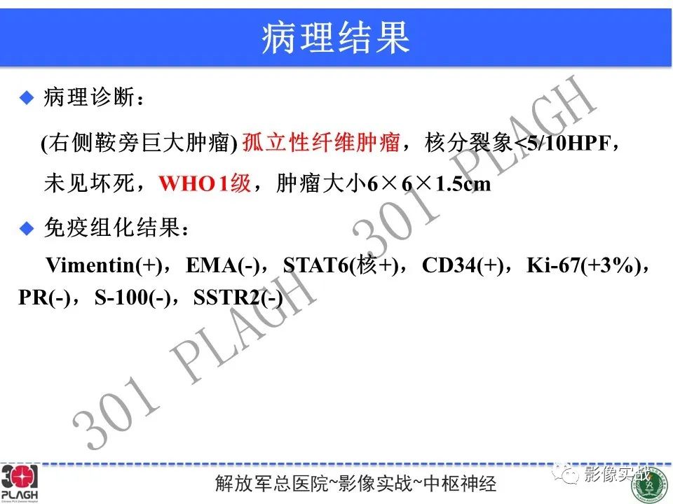 【病例】鞍区孤立性纤维瘤1例CT及MR影像-23
