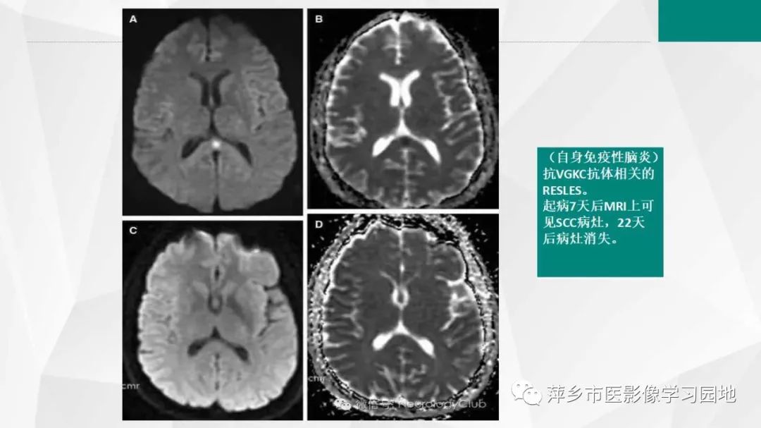 【PPT】可逆性胼胝体压部病变综合征-19