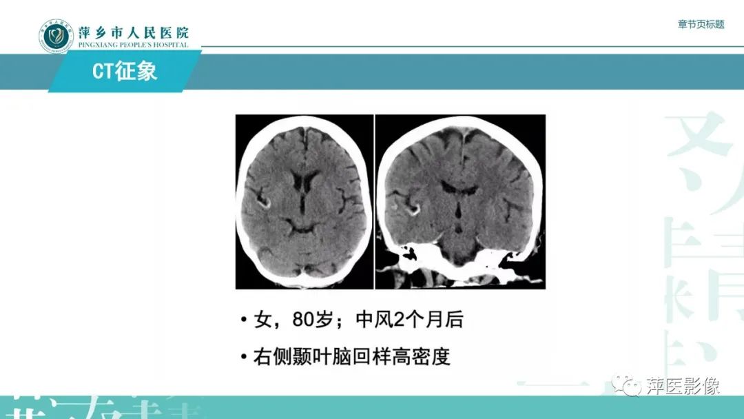 【PPT】脑皮质层状坏死的影像诊断-17