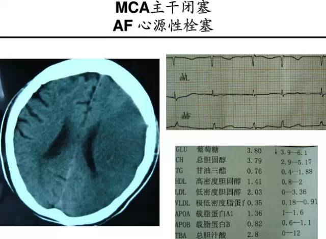【PPT】猜责任血管与发病机制-66