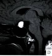 【病例】Rathke囊肿1例MR影像表现