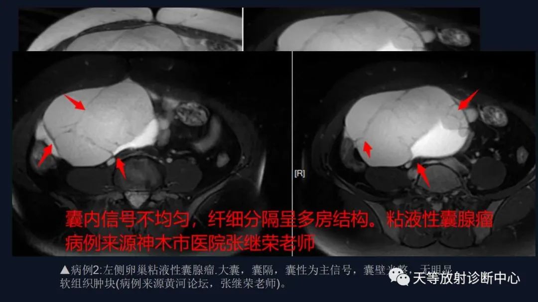 【病例】卵巢囊腺瘤1例MR影像-27