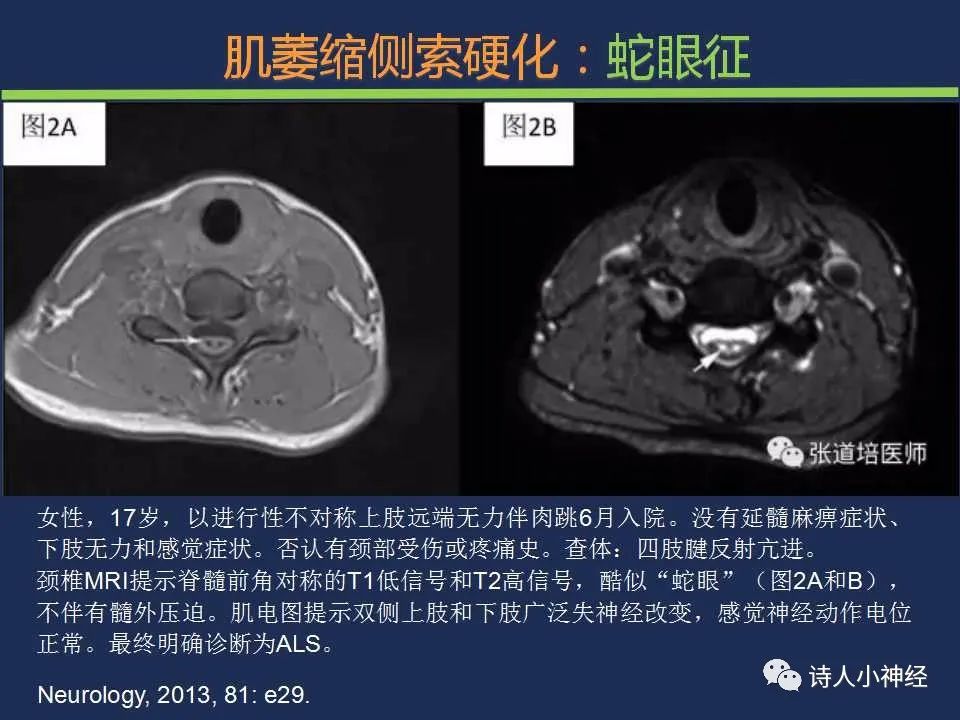 【PPT】“蛇眼征”影像汇总-11