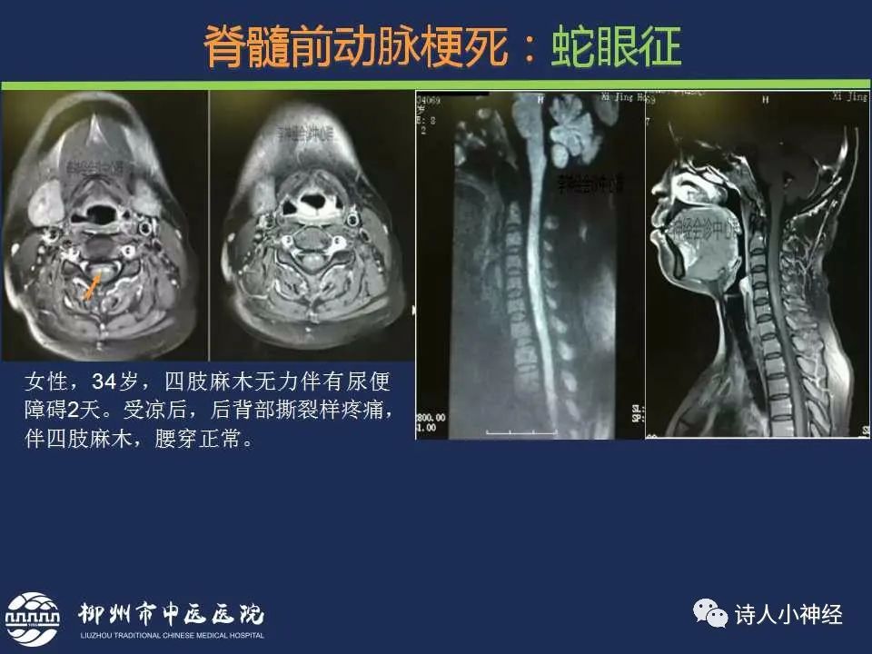【PPT】“蛇眼征”影像汇总-16
