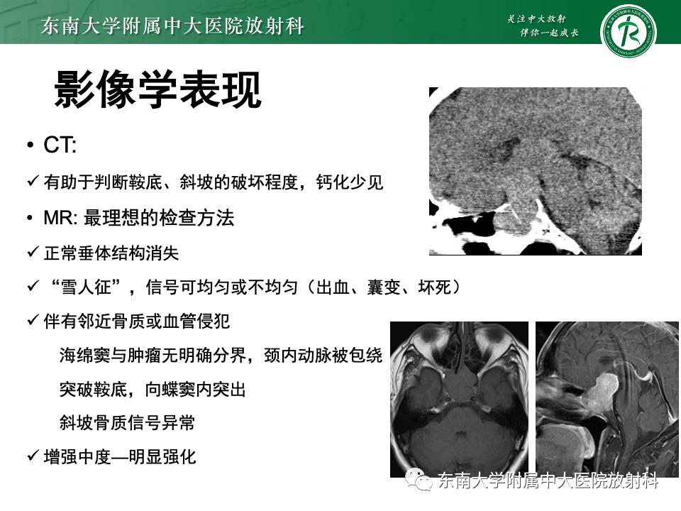 【PPT】斜坡骨质破坏性病变影像诊断-38