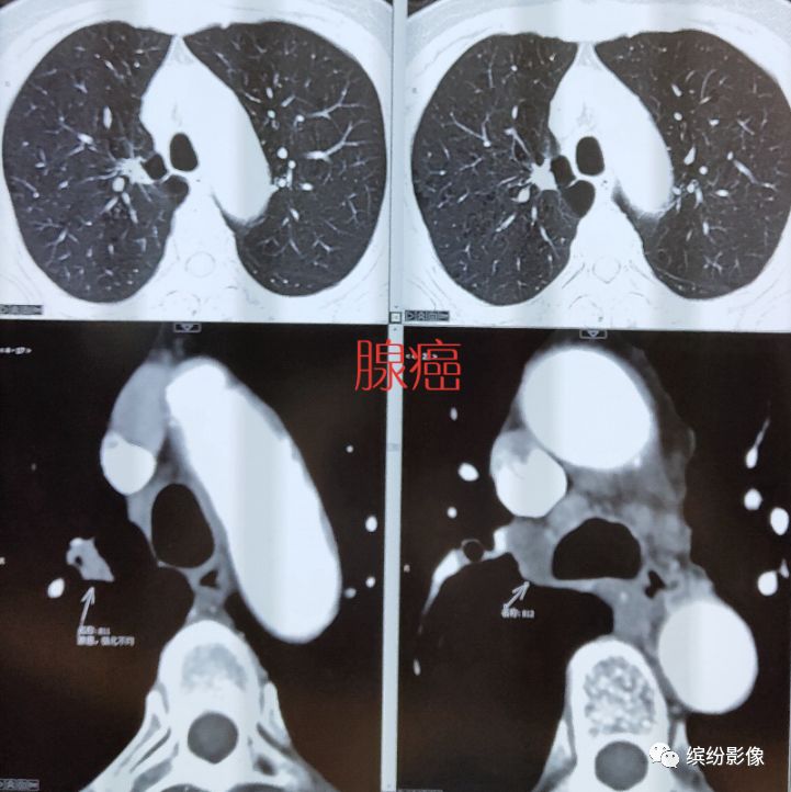 肺癌病例读片解析-5