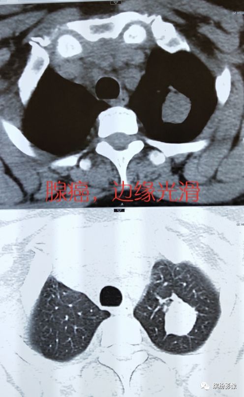 肺癌病例读片解析-12