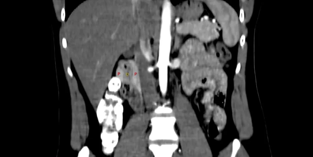 【病例】完全性环状胰腺1例CT影像-9