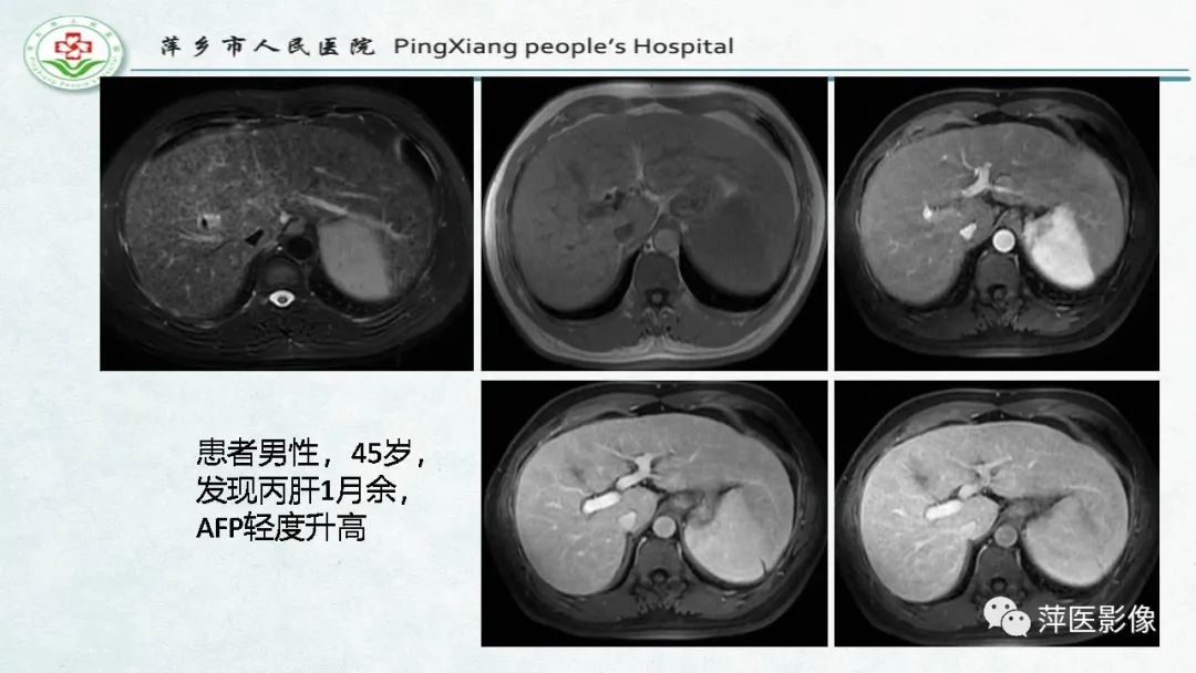 【PPT】HCC影像诊断思路-23