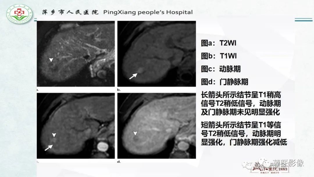 【PPT】HCC影像诊断思路-28