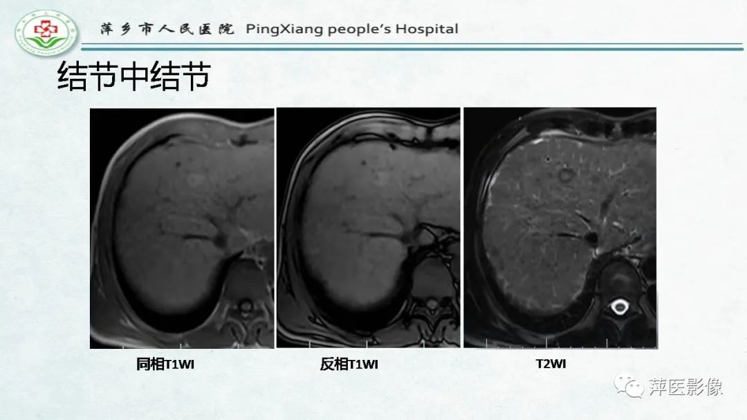 【PPT】HCC影像诊断思路-49