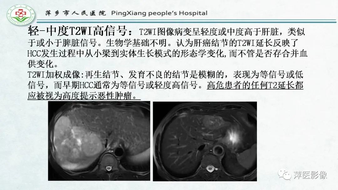 【PPT】HCC影像诊断思路-54