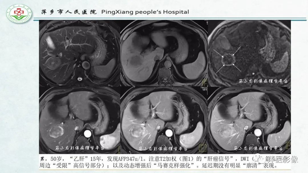 【PPT】HCC影像诊断思路-56