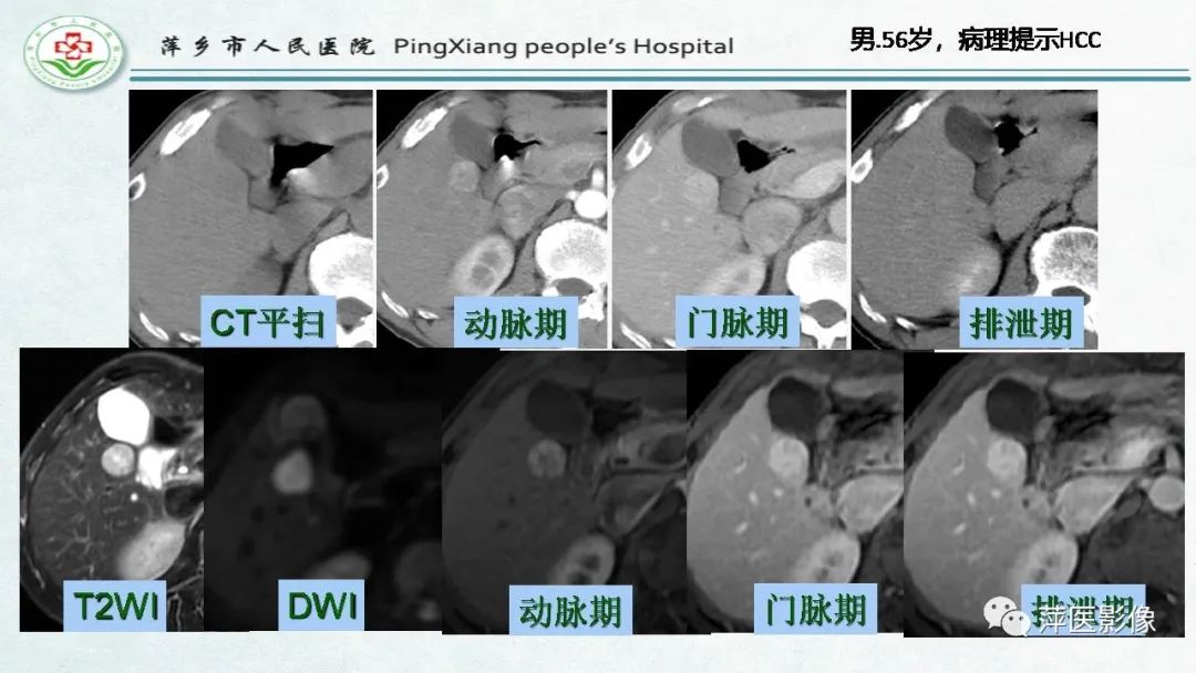 【PPT】HCC影像诊断思路-60