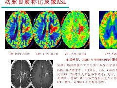 脑灌注成像原理及在临床中的应用