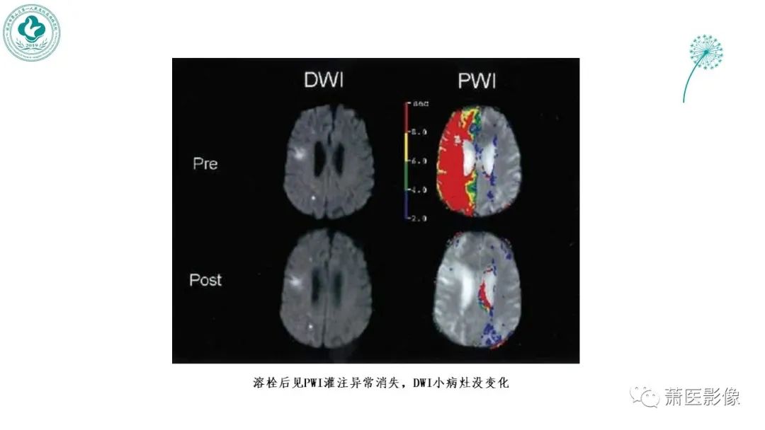 【PPT】脑灌注成像原理及在临床中的应用-35