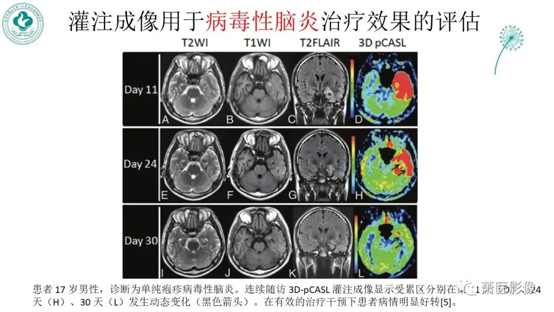 【PPT】脑灌注成像原理及在临床中的应用-44