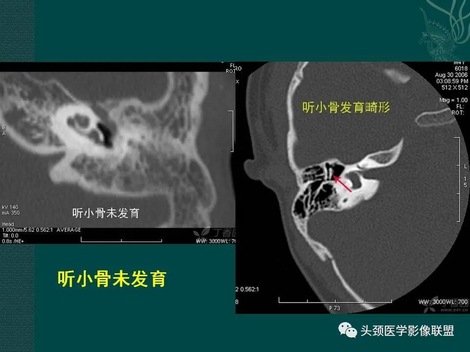 【PPT】耳部常见疾病影像表现-73