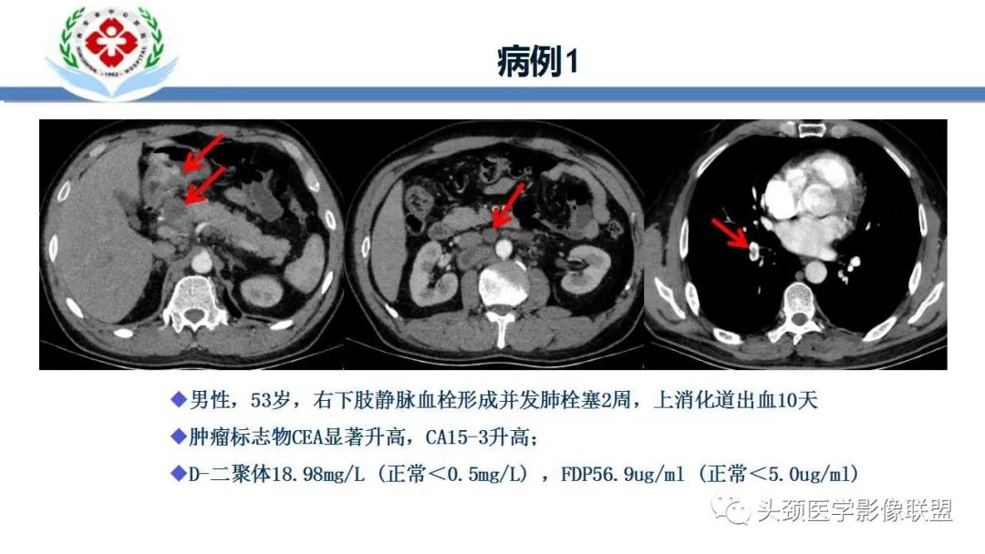 【PPT】特鲁索综合征-2