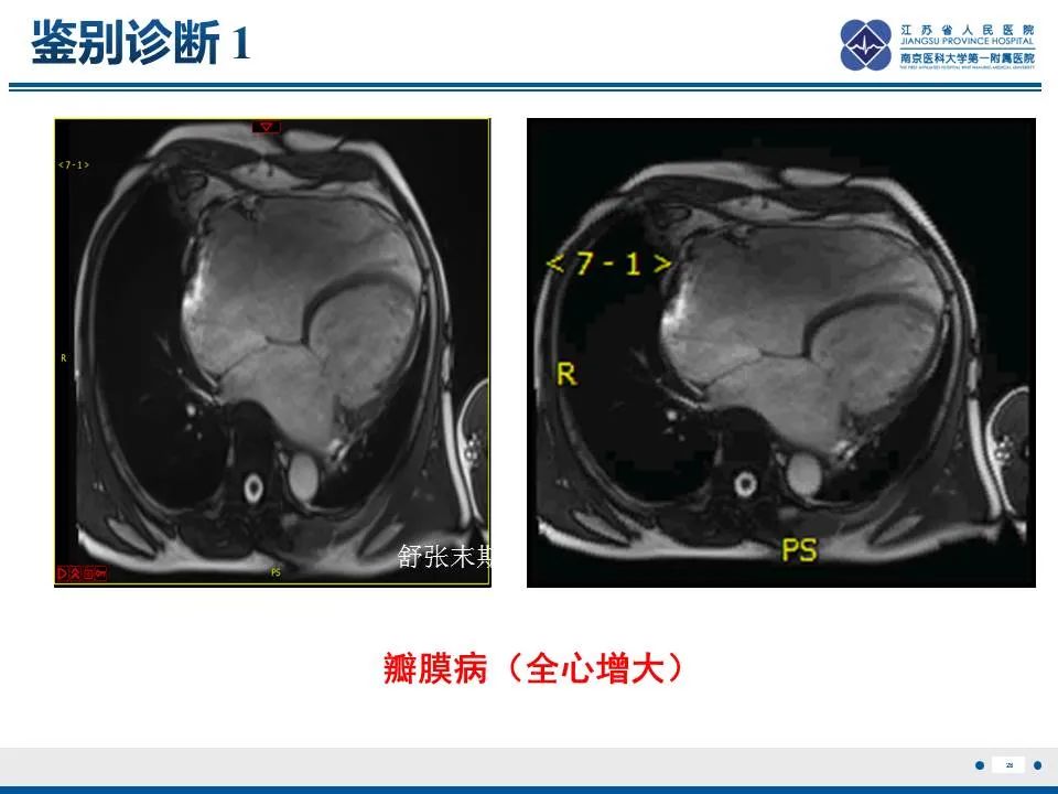 【PPT】直背综合征-29