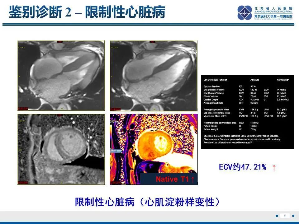 【PPT】直背综合征-32