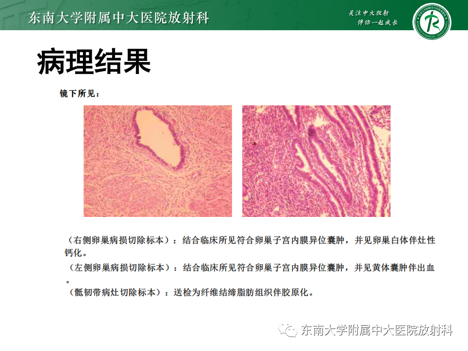 【PPT】子宫内膜异位症-20