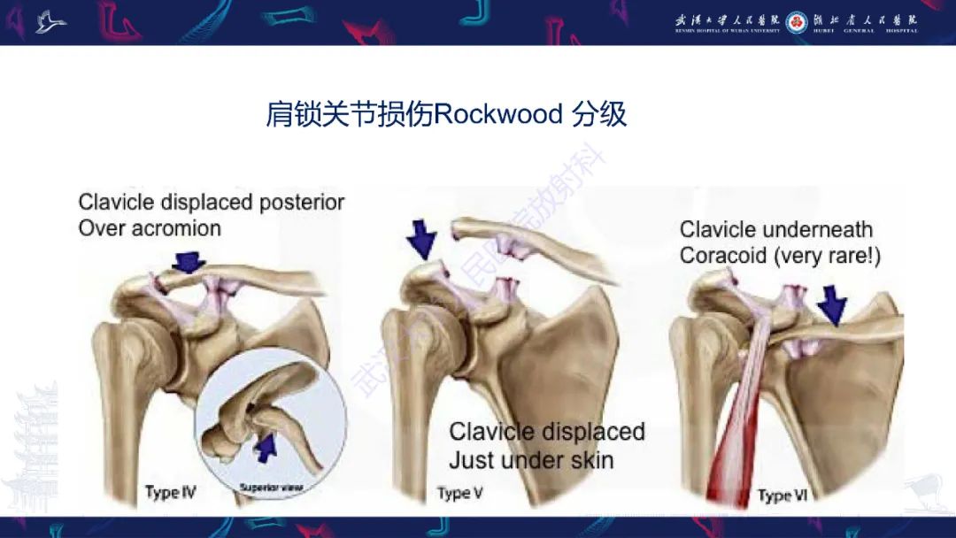 【PPT】肩锁关节病变影像诊断-29