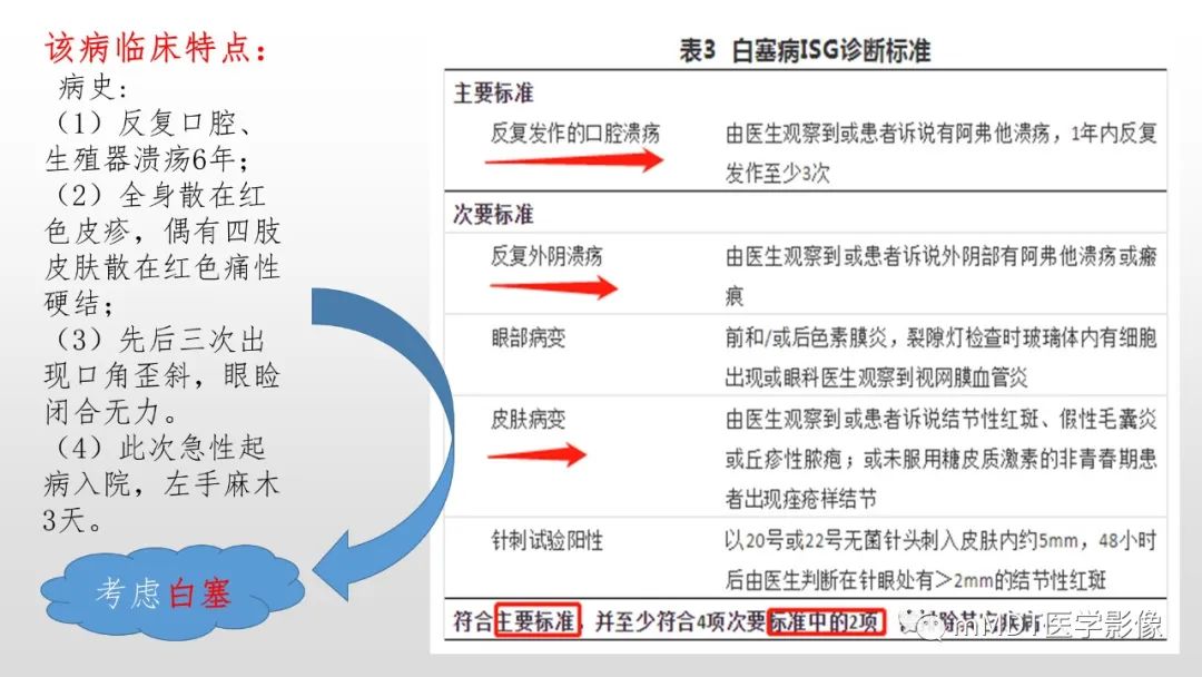 【PPT】神经白塞病NBD-9