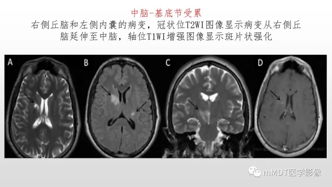 【PPT】神经白塞病NBD-28