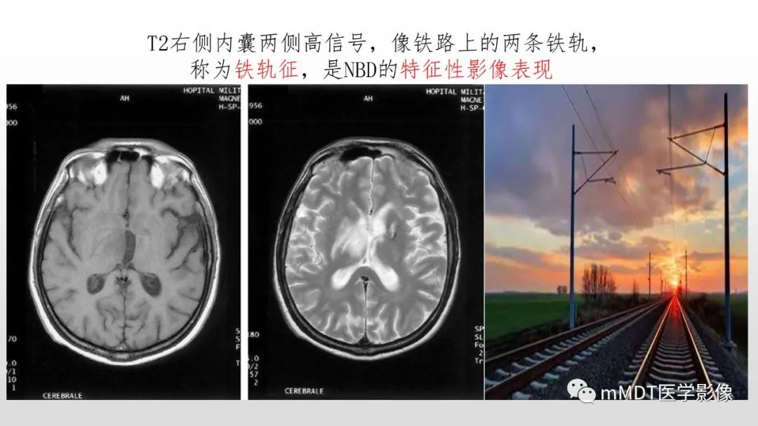 【PPT】神经白塞病NBD-33