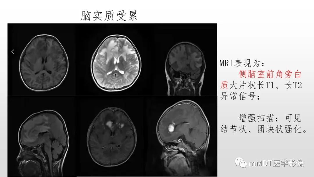 【PPT】神经白塞病NBD-34
