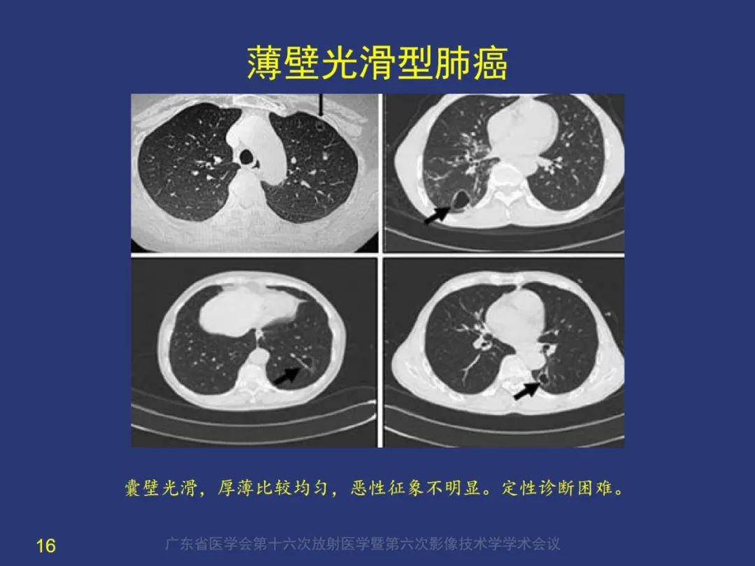 【PPT】囊腔性肺癌的影像特征和鉴别诊断-16