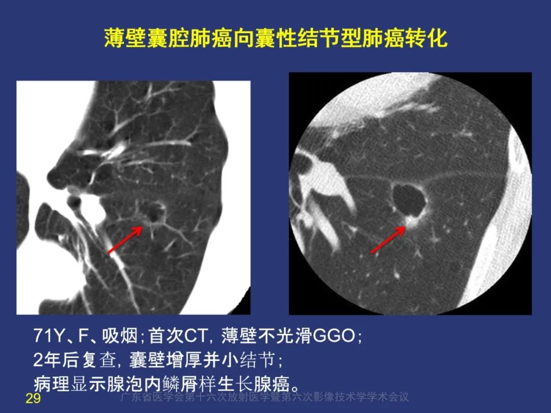 【PPT】囊腔性肺癌的影像特征和鉴别诊断-29
