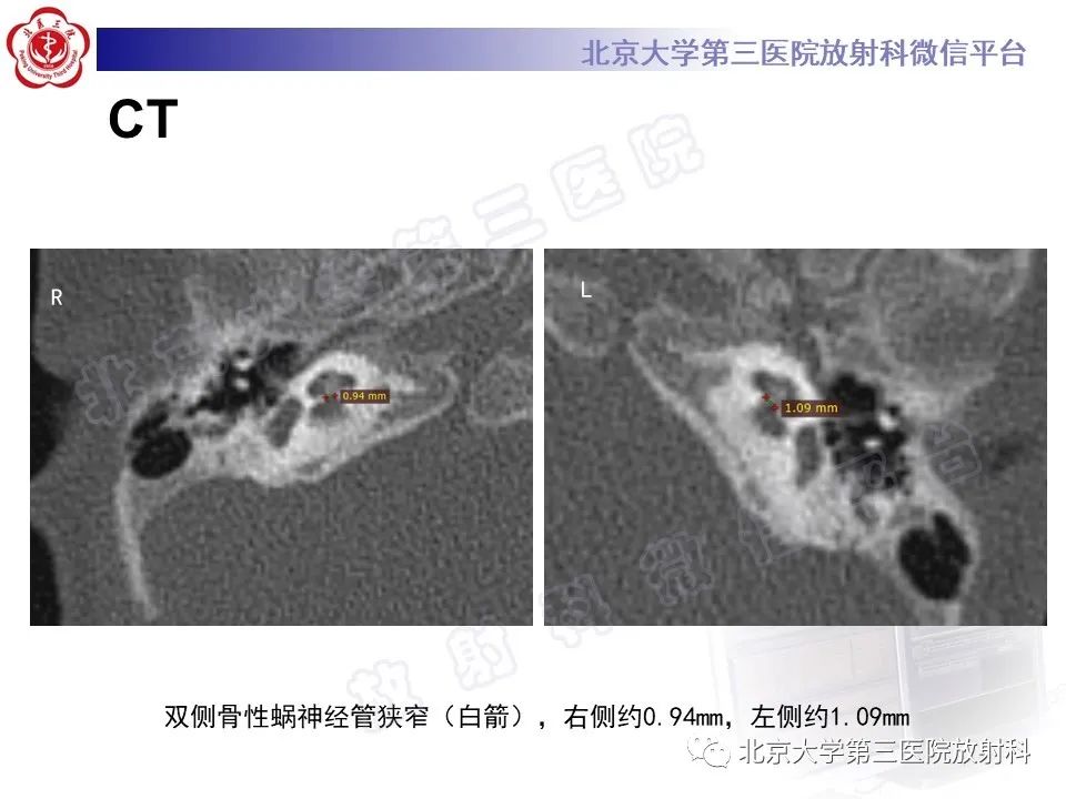 【PPT】内耳发育畸形-5