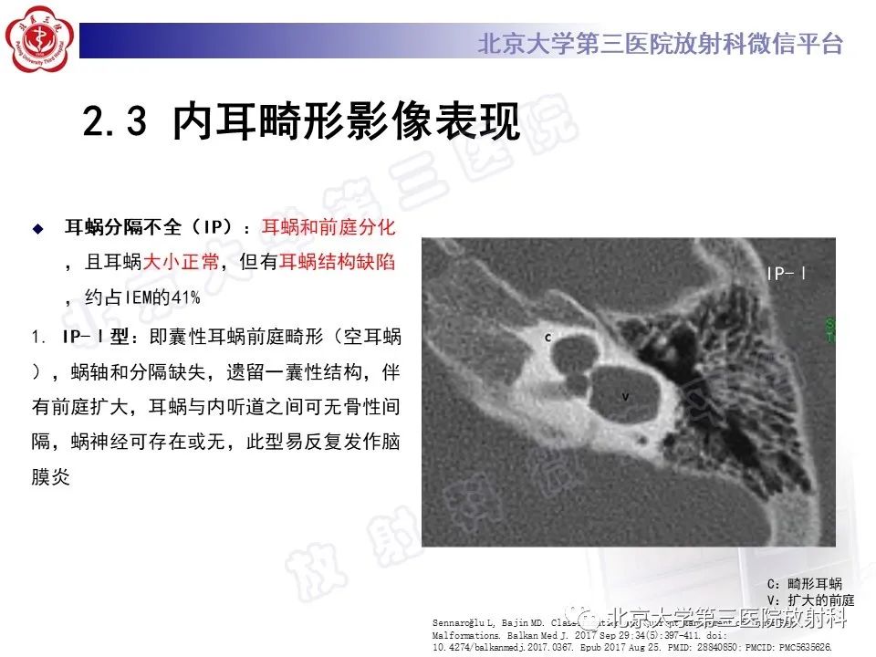 【PPT】内耳发育畸形-29