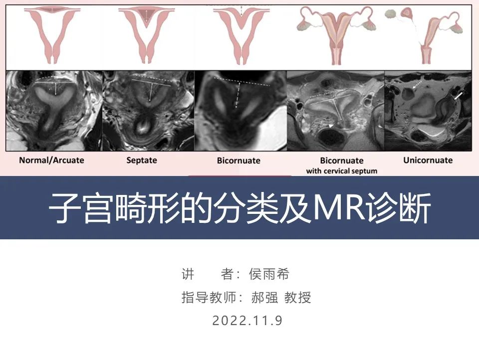 子宫畸形的分类及MR诊断