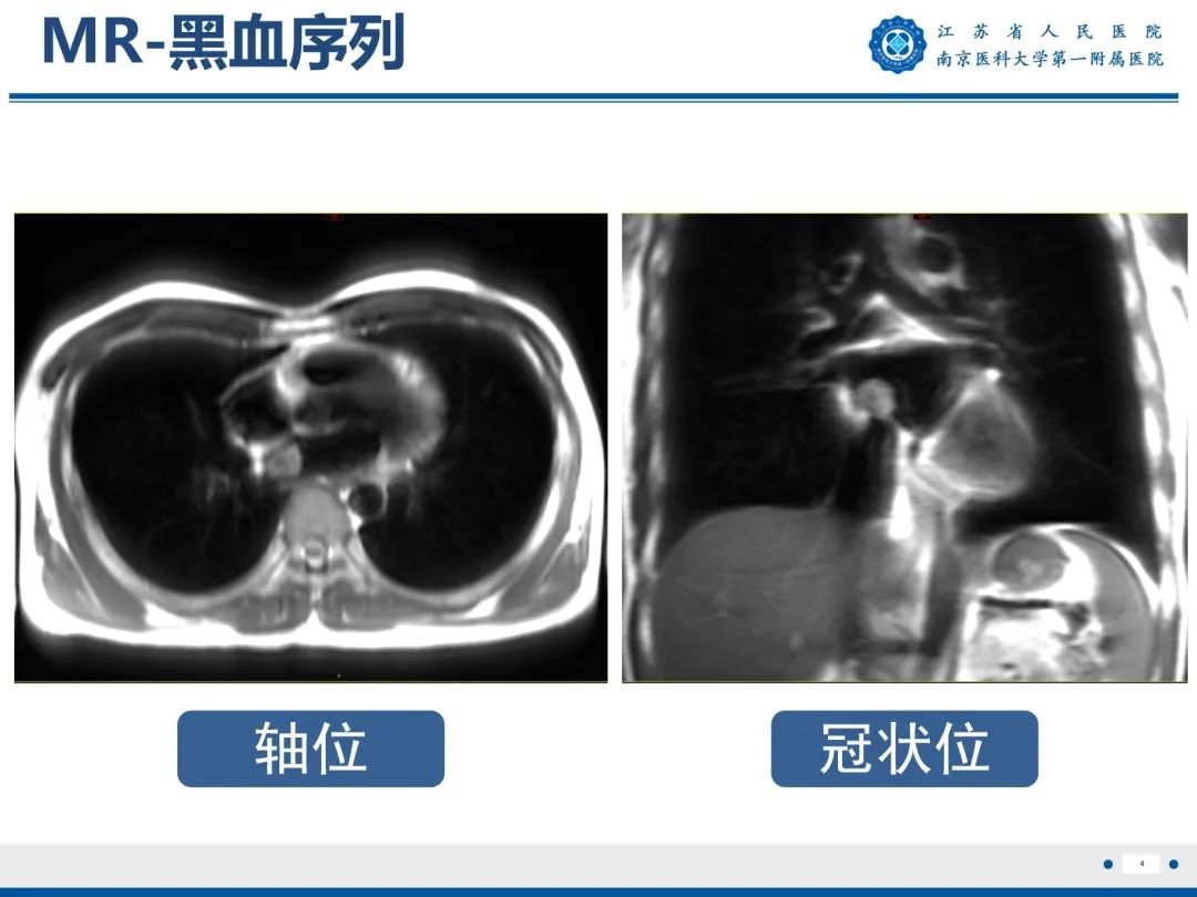 【PPT】心脏黏液瘤—心脏肿瘤MR评估-5