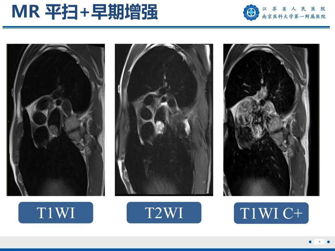 【PPT】心脏黏液瘤—心脏肿瘤MR评估-6