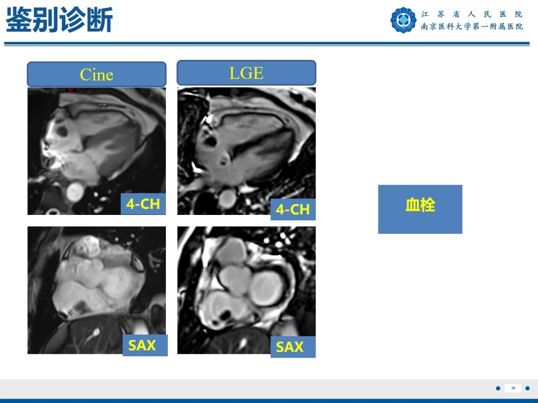 【PPT】心脏黏液瘤—心脏肿瘤MR评估-31